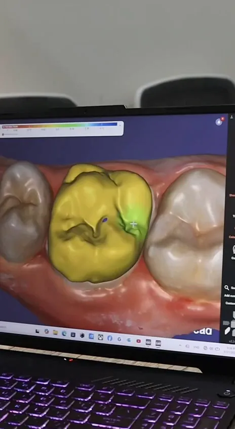 تصميم تاج على برنامج exocad