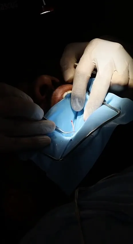 علاج جذور مع عزل السن